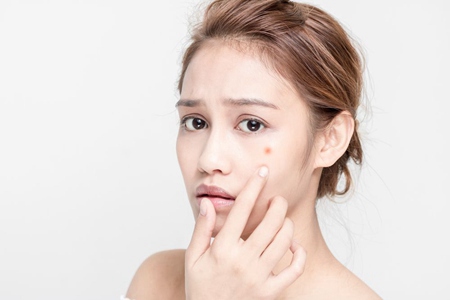 面部痤疮若何治疗，女性针对分歧肤质进行治疗最佳体例