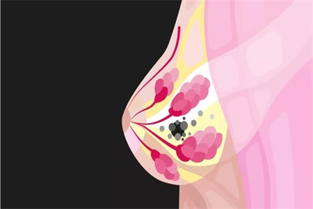 乳腺癌是怎么引起的？什么人容易得乳腺癌？女性要注意