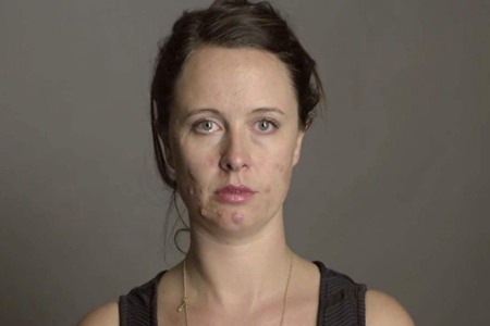 下巴长痘痘是什么原因，女性面部痤疮的四个调理方法