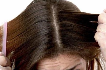 头皮屑多是什么原因 女性对抗头皮屑这三步是关键
