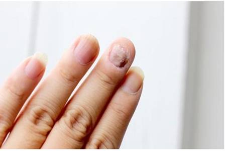 最轻微的灰指甲图片有什么症状，灰指甲怎么治愈最快