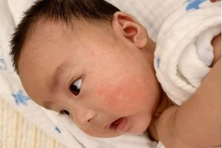 婴儿湿疹最佳治疗方法，五个方法解决宝宝红肿湿疹