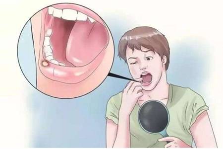 口腔溃疡发病六大原因，小妙招让你远离溃疡疼痛