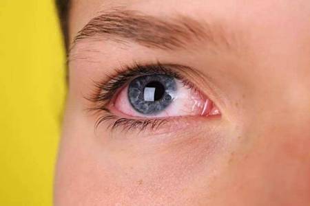 眼睛红血丝是怎么回事，眼睛疲劳发红的五大原因要重视