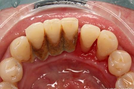 洗牙对牙齿有伤害吗，洗牙的注意事项有哪些