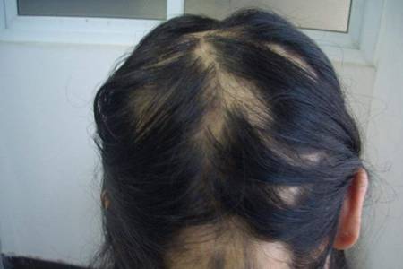 女人脂溢性脱发怎么办 脂溢性脱发最佳治疗方法大全