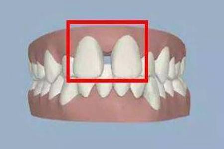牙缝大是什么原因造成的  牙缝大怎么办如何修复最好