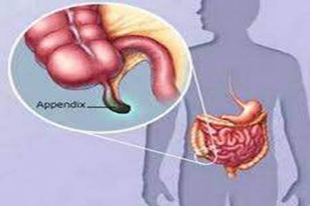 阑尾炎的症状  如何有效治疗阑尾炎