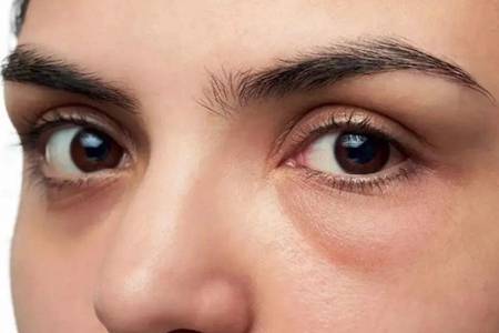 眼睛水肿怎么办如何快速有效消肿  睡觉前喝水眼睛会浮肿吗