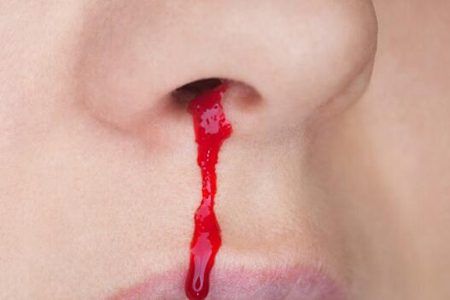 流鼻血是什么原因引起的呢？这5个因素有关及时改善