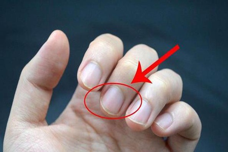 指甲凹凸不平是什么原因 谨记这3点是疾病预警