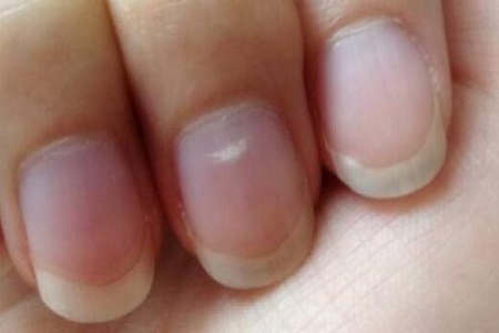 指甲上有白色斑点是怎么回事？这四个因素造成的及时治疗
