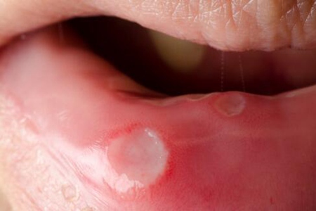口腔溃疡是什么原因造成？这五个原因真希望能早点发现