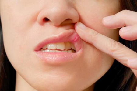 口腔溃疡是什么原因造成？这五个原因真希望能早点发现
