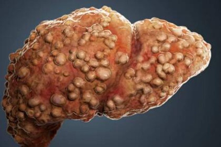 乙肝是怎么转成肝癌的？这三个因素在推波助澜要改善