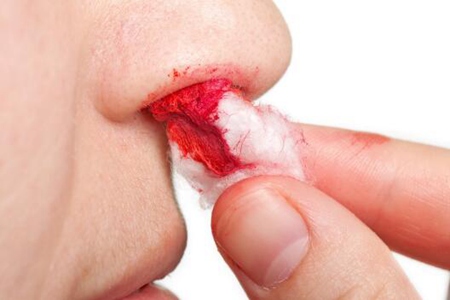 鼻子流鼻血什么原因导致的？（这五个流鼻血的原因及时改善）