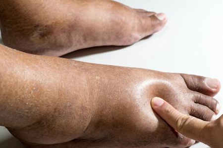 老年人脚肿是怎么回事？这五个疾病因素导致脚浮肿