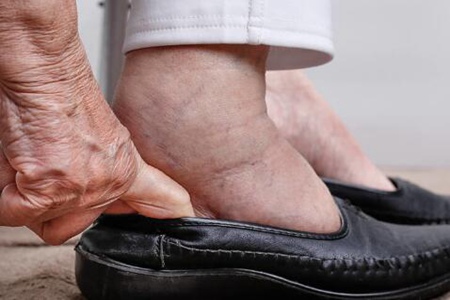 老年人脚肿是怎么回事？这五个疾病因素导致脚浮肿