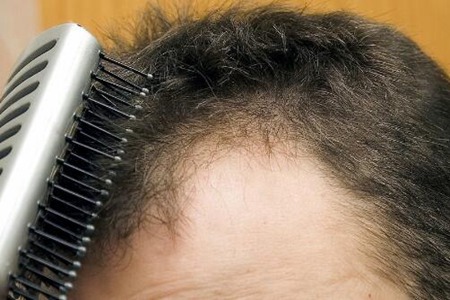 掉头发男性是什么原因？这五个关键因素必须重视改善