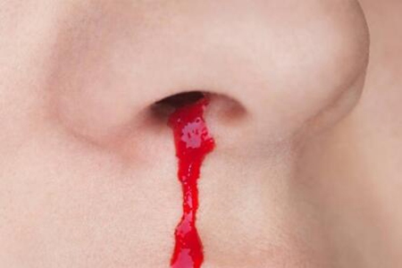 鼻子出血是什么原因？这五个原因引发及时改善治疗