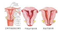 引起子宫畸形的原因 月经异常当心 双子宫