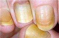 肝受损时指甲会有一些表现，指甲上有竖纹是怎么回事？