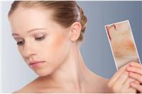 皮肤过敏症状有哪些，女性皮肤初期过敏如何治疗