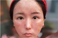 激素脸有哪些症状，女性激素脸如何治疗调理皮肤