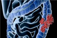 大肠癌的早期症状有哪些 怎么预防大肠癌的发生