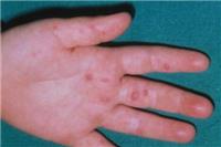 手足口病的主要症状？这五个症状早发生早治疗