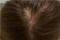 头发少怎么增加发量？这五个方法头发变得浓密