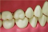 磨牙是什么原因引起？这五个原因有关值得重视改善