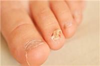 灰指甲是什么原因造成的？这五个原因造成得杜绝传染机会