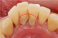 牙结石的危害有什么？这四个危害要及时改善别毁掉牙