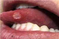舌头上溃疡怎么治？这四个方法能快速愈合溃疡