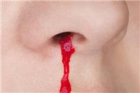 鼻子出血是什么原因？这五个原因引发及时改善治疗