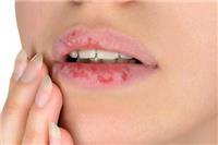 嘴唇干裂脱皮怎么快速恢复？这4个好方法帮你来改善