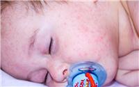 母乳喂养可以治愈湿疹吗?宝宝得了湿疹怎么办?