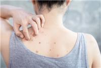 背上有痘痘对身体健康是否有影响?背上长痘会传染吗?