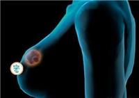 乳腺肿瘤早期会有什么症状